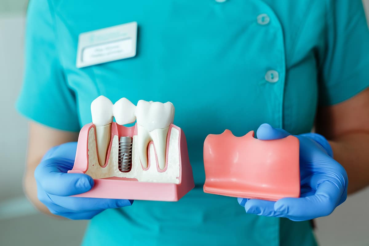 Dental Implant