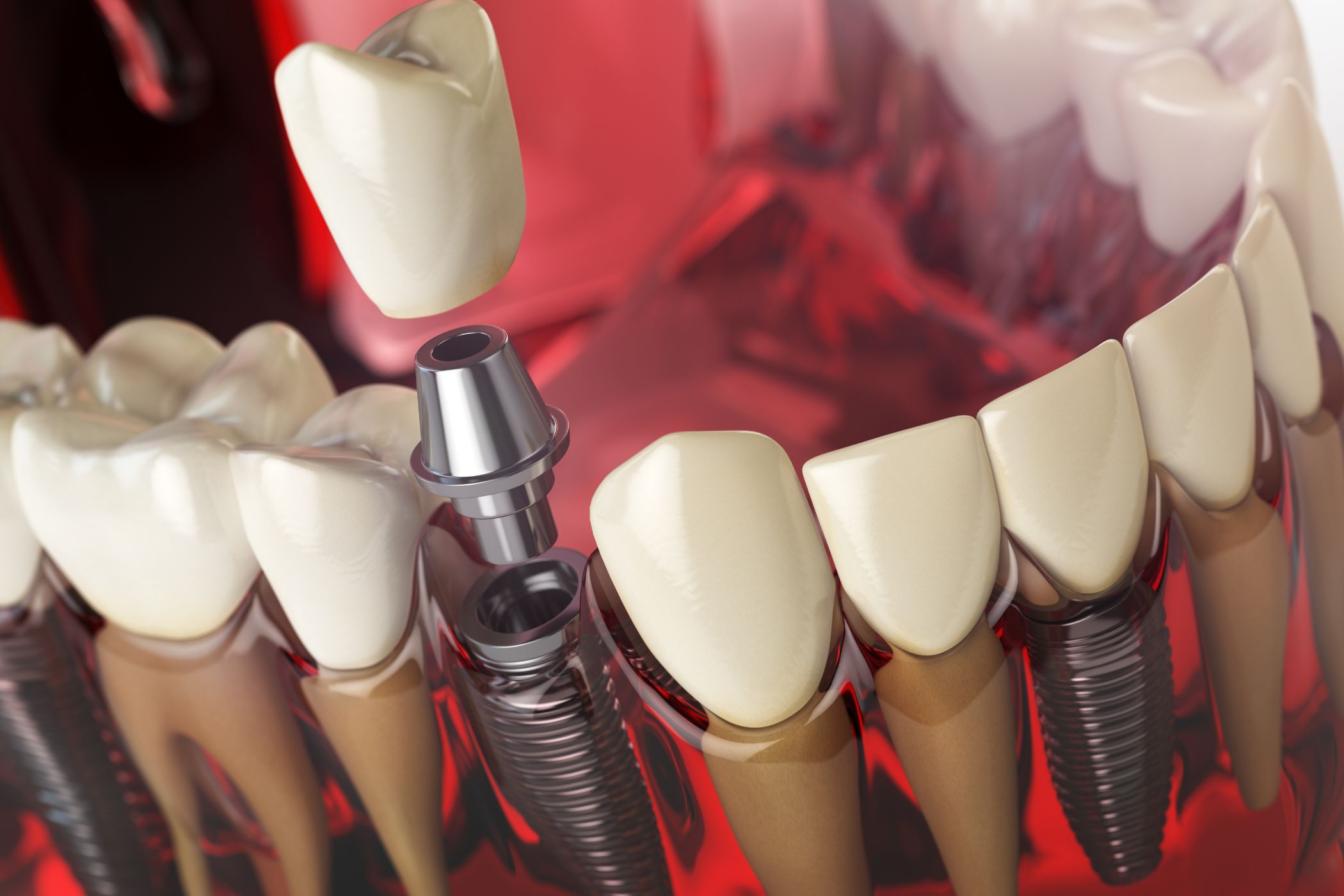dental implants worth it