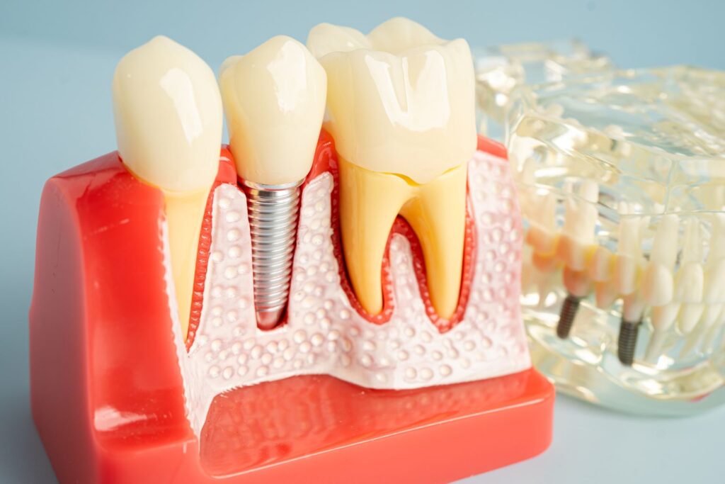 how do dental implants work