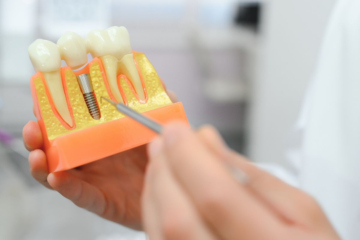 how long do dental implants last