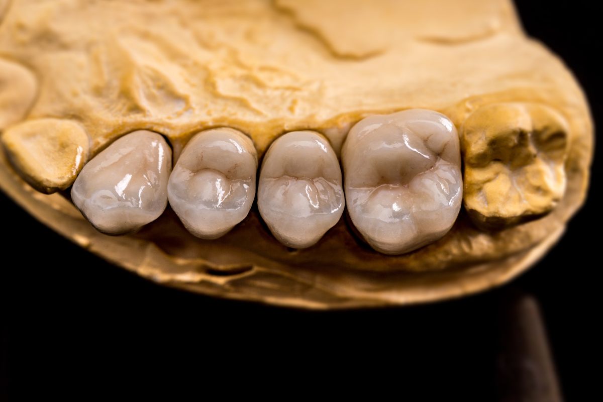 dental crowns improve our smile aesthetics